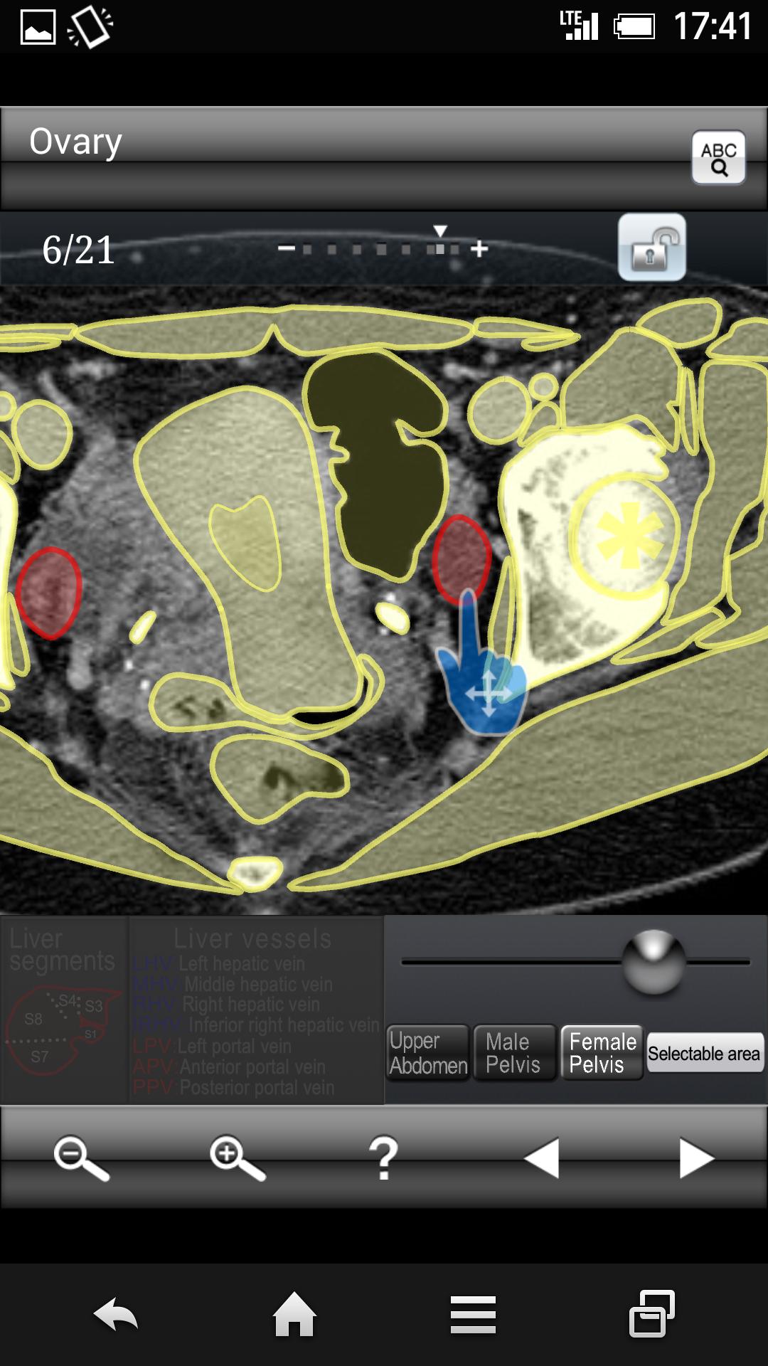 AbdominalCTSectionalWalkerLite
